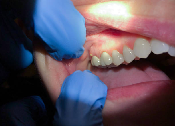 Best Broken or Cracked Tooth Emergency Dentist in Hagerstown, IN